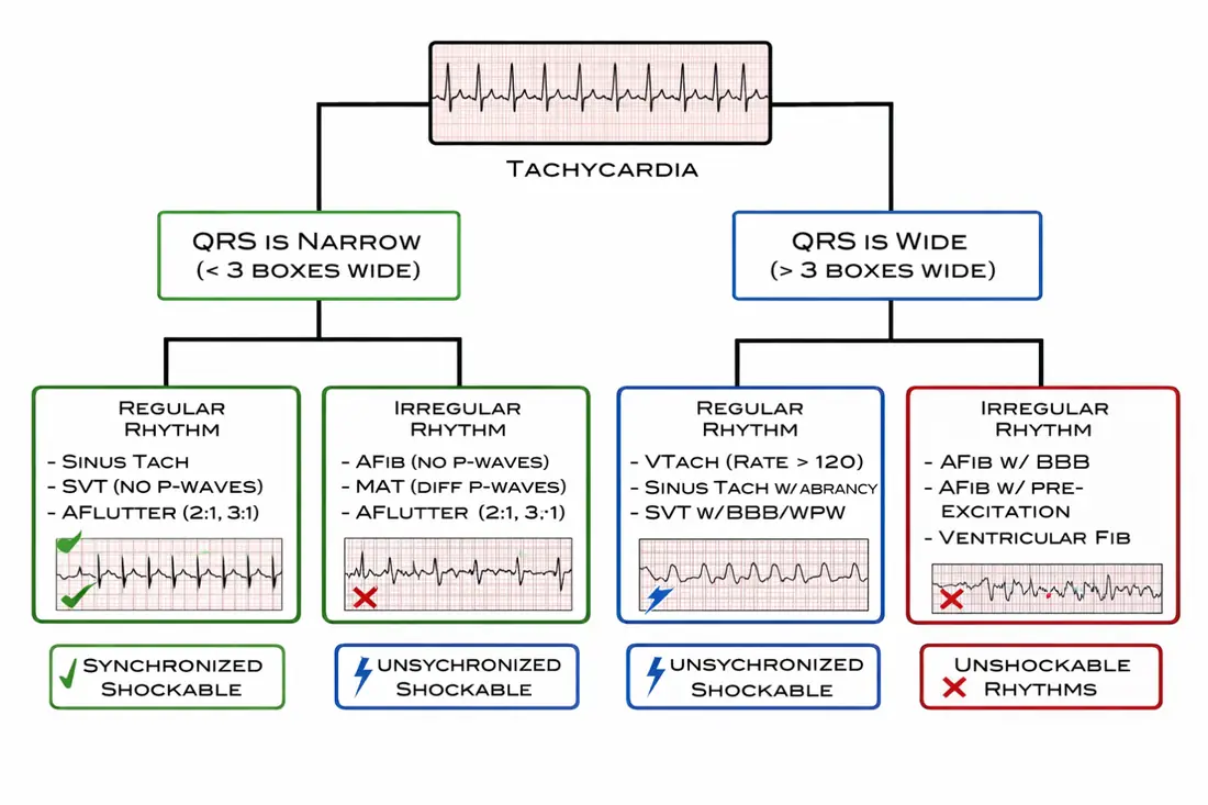 Tachycardia Algorithm — Narrow vs wide QRS, regular vs irregular